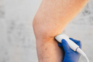 The,Time,Varicose,Vein,Treatment,Takes,Includes,Ultrasound,Scan.
