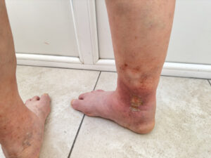 Venous,Ulcer,On,Lower,Leg