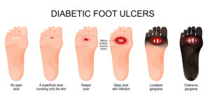 Illustration,Of,Progression,Of,Diabetic,Foot,Ulcers.