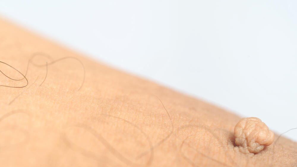 Close,Up,On,Large,Skin,Tag,On,Man's,Arm,