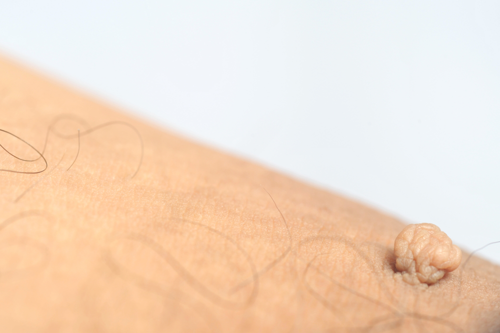 Close,Up,On,Large,Skin,Tag,On,Man's,Arm,