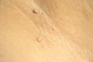 Skin,Tag,Removal,Is,A,Quick,Procedure,By,A,Surgeon