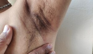 Skin,Tag,Removal,Needed,On,Man's,Underarm.