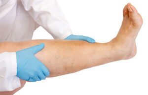 Vascular,Specialist,Examines,Leg,Swelling,And,Swollen,Ankles.