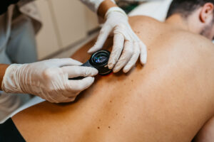 Suspicious,Lumps,And,Bumps,Being,Investigated,Melanoma