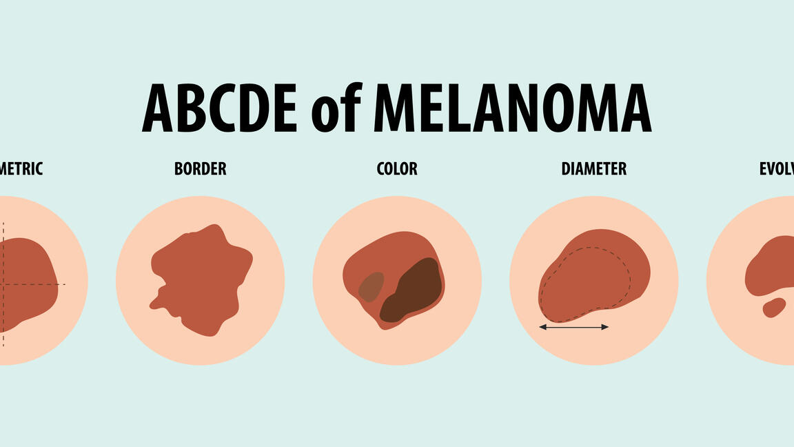 Illustration,Of,ABCDE,Of,Melanoma.