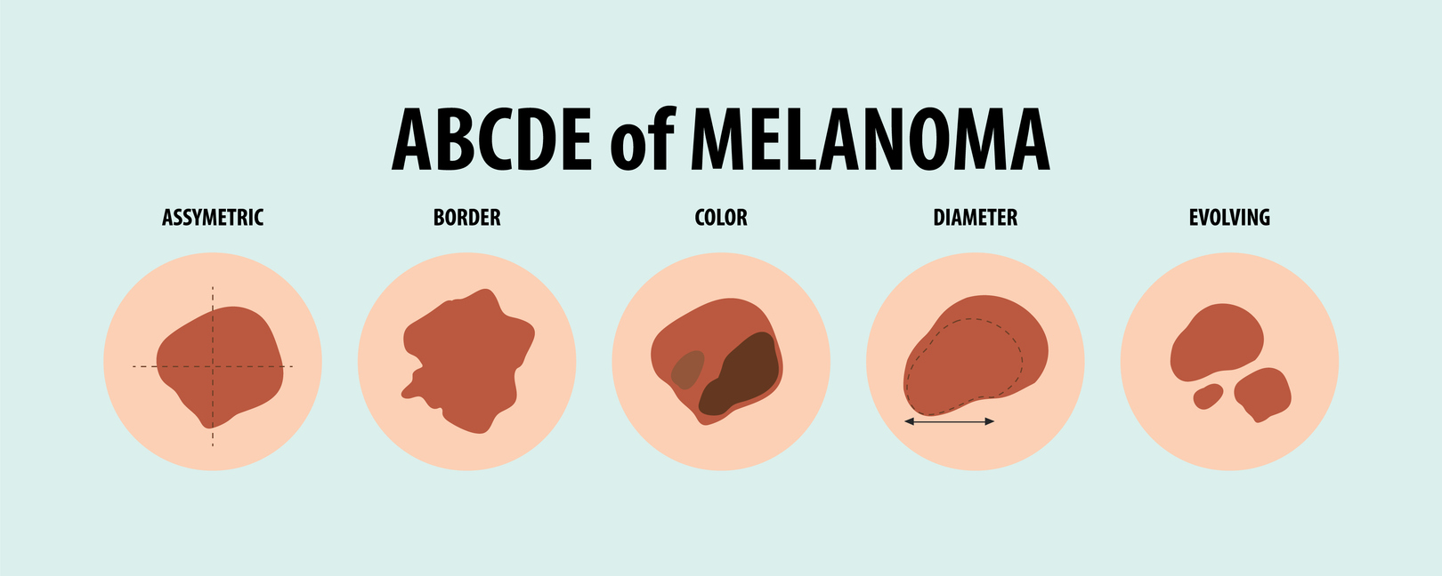 Illustration,Of,ABCDE,Of,Melanoma.