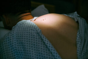 Male,Prepared,For,Mole,Removal,Back,Exposed,Around,The,Mole,Wearing,Hospital,Gown,Mole,Is,Highlighted..