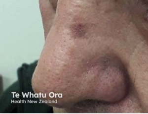 Sunspot,On,Male,Nose,Cancer,Society