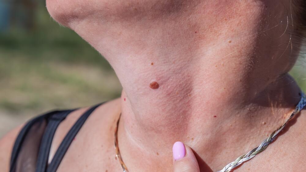 Mole,On,Neck,Needs,Checking.