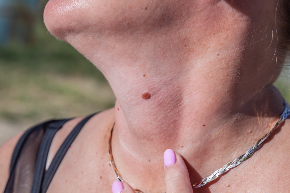 Mole,On,Neck,Needs,Checking.