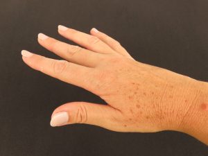 Woman's,Hand,Outstretched,Several,Sunspots.