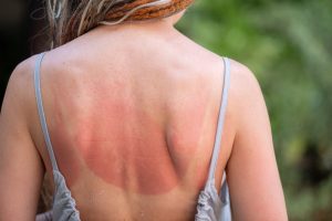 Sunburned,Skin,On,Woman's,Back,Outline,Of,Clothing,Visible.